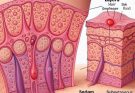 Acne: Understanding the Common Skin Condition Affecting Millions Worldwide